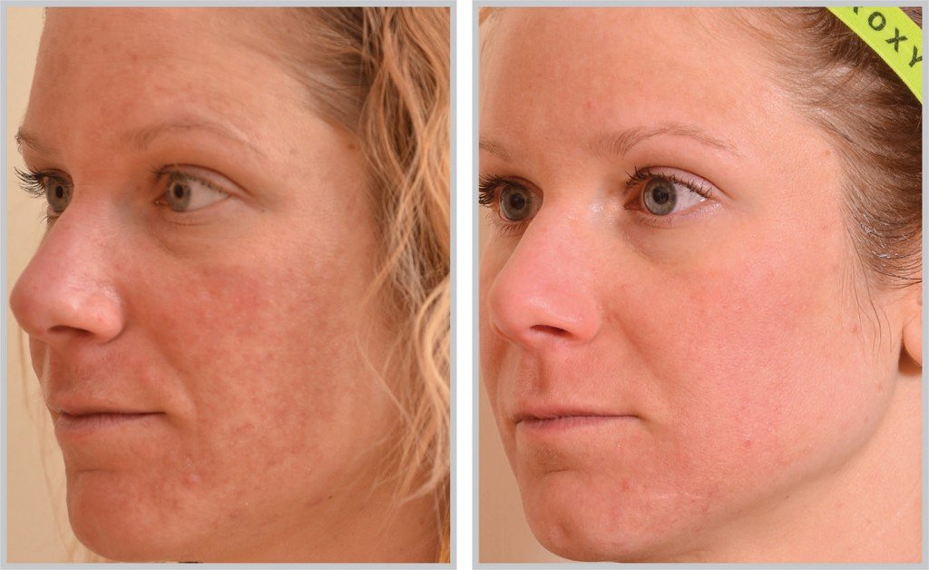 synergy_halo-laser-sun-damage-smooth-before-after