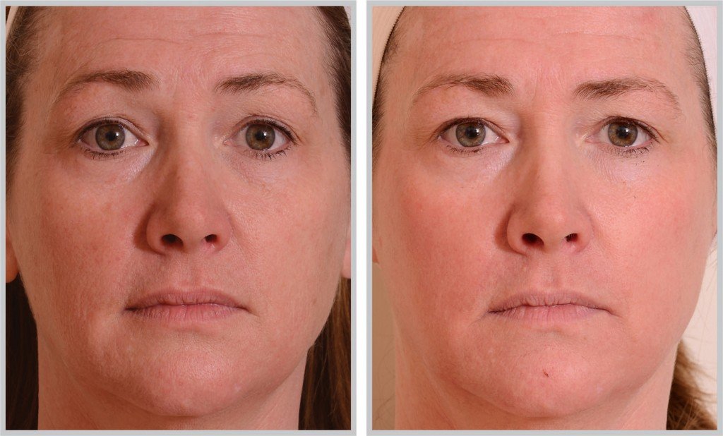 synergy_halo-laser-sun-damage-smooth-before-after-5-1024x618